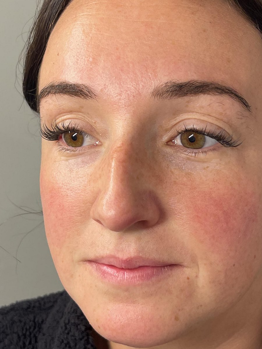 The same client's skin after treatment
