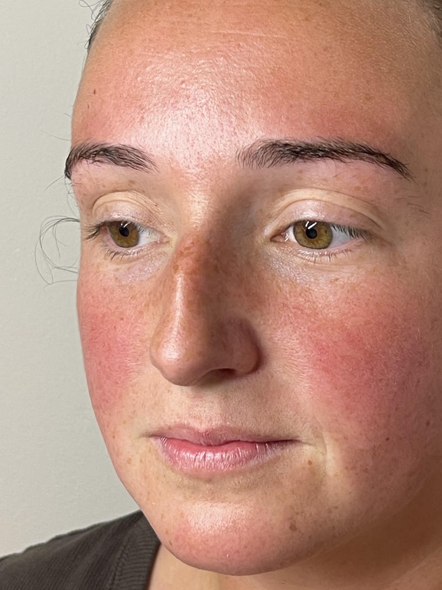 Client's skin before treatment