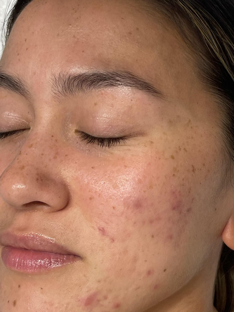 The same client's skin after treatment