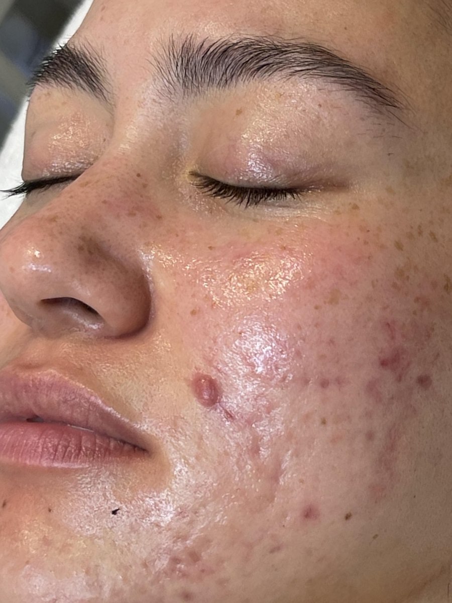 Client's skin before treatment