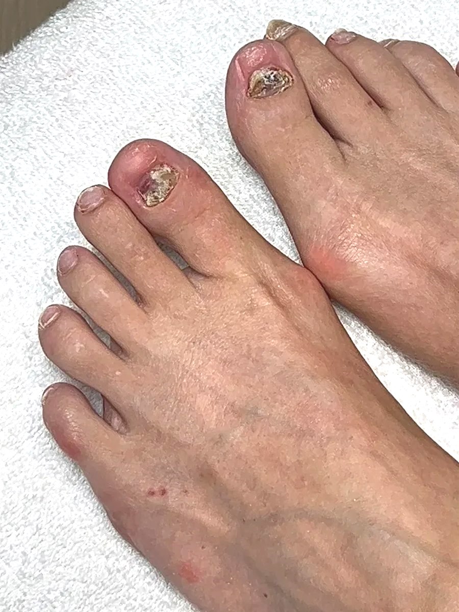 Client's toenails before a Nail Restore Pedicure